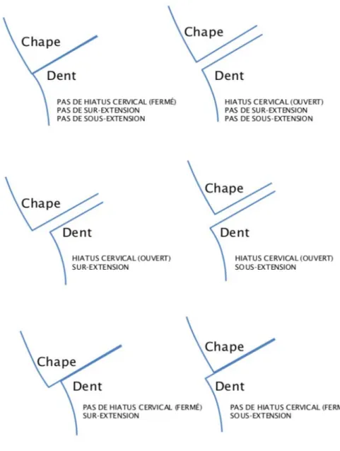 Figure 3 : Les types d'ajustage marginaux(5,8) 