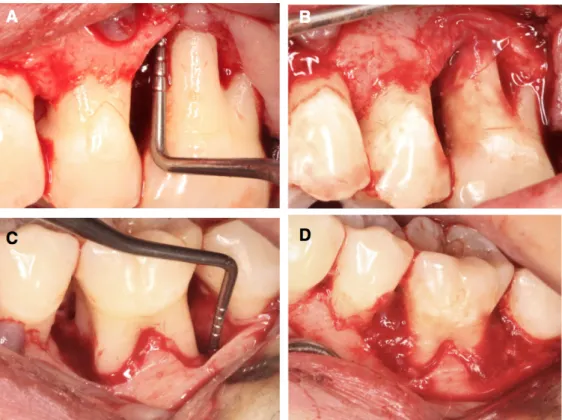Figure 14: Vue clinique de la procédure chirurgicale a: défaut de 7 mm en mésial de la première molaire supérieure après  levée du lambeau b: application de la membrane amnion/chorion c: défaut distal de 5mm en distal de la première molaire  mandibulaire a
