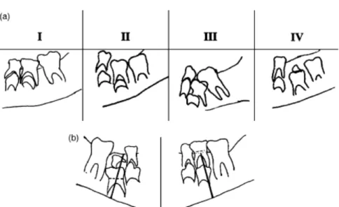 Figure 6 : (a) Représentation schématique des quatre groupes indiquant les différents niveaux  de gravité d’inclusion de la 2ème molaire temporaire du côté droit de la mandibule