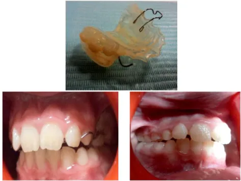 Figure 26 : Photographies après réingression des dents du secteur mandibulaire gauche