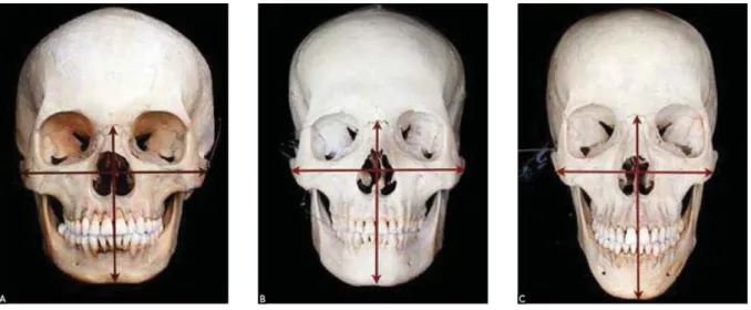 Figure 3 L’indice facial (distance ophryon-gnathion sur la distance bizygomatique x100) permet de définir 3 types de faces  dont l’euryprosope qui possède une face large (IF&lt;97) et le leptoprosope avec une longue face (IF&gt;104).(15)  
