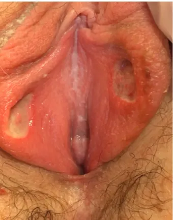 Figure 1: Symmetric ulcerations of inner labia minor known  as  «  kissing  lesions  »,  two  deep,  centimetric  and  fibrinous  ulcerations.