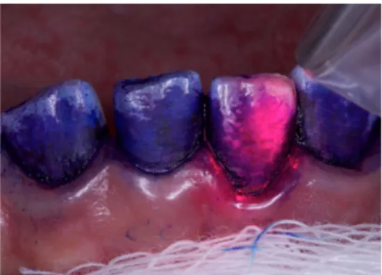 Figure 5: Application de thérapie photodynamique avec un laser InGaAlP, 660nm, 100mW, 70 J/cm2,  23 s/surface dentaire, sur des dents enduites de solution à base de bleu de Toluidine (11) 