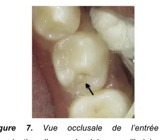 Figure 6. Puits cingulaires différents des deux  incisives latérales maxillaires (4)  