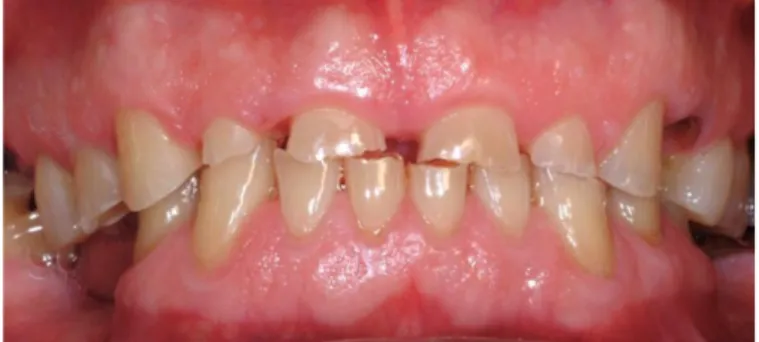 Figure 9: Lésions attritives avec correspondance maxillaire et mandibulaire en OIM 