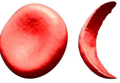 Figure 1: Globule rouge normal (à gauche), globule rouge falciformé à droite (7)  La drépanocytose présente 5 haplotypes : 