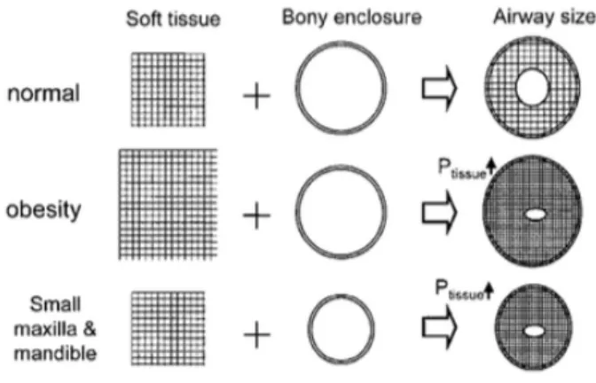 Figure 1 : Représentation schématique de l’interaction entre les tissus mous et l’enceinte  osseuse des voies aériennes supérieures et son effet sur le flux d’air (18) 