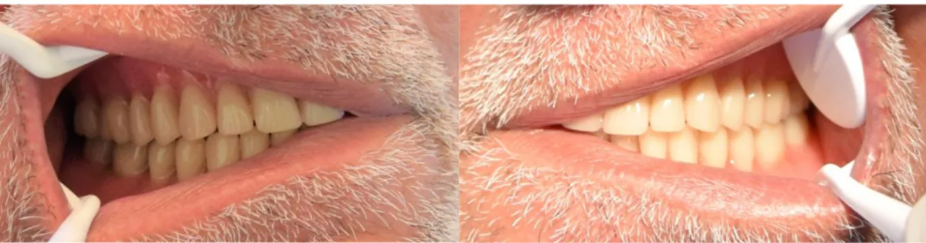 Figure 26 : Nouvelles prothèses occlusion droite     Figure 27 : Nouvelles prothèses occlusion gauche 