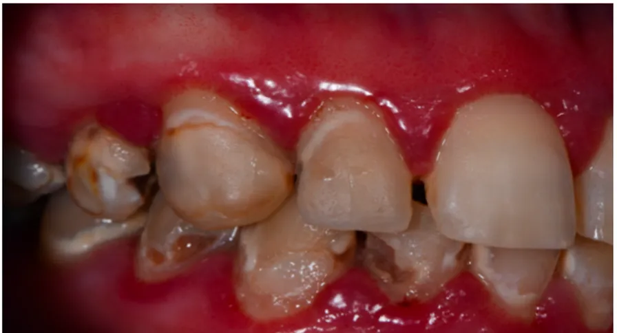 Figure 5 : Leucome pré-carieux. 