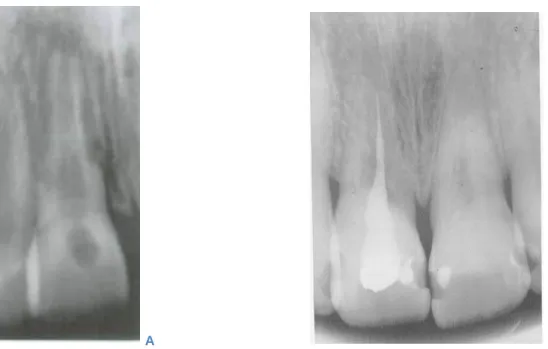 Figure 2 :   A : Radiographie d'une dent présentant une résorption externe inflammatoire  résultant d'une infection pulpaire