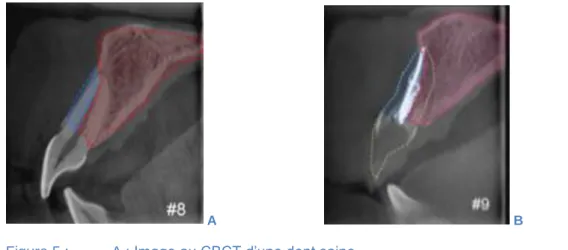 Figure 5 :    A : Image au CBCT d’une dent saine 