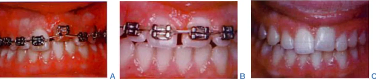 Figure 9 : Tentative de traction orthodontique d’une 21 ankylosée.   