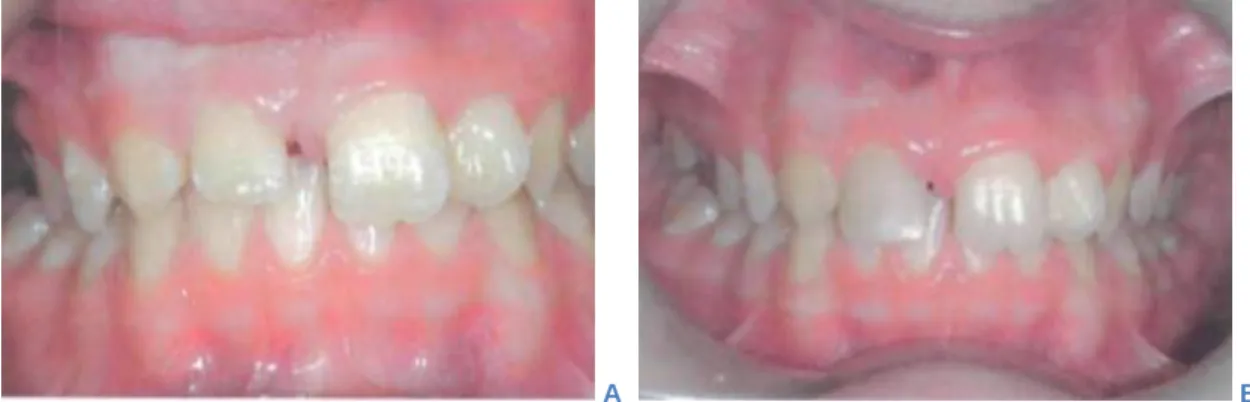 Figure 11 :  Exemple d’un cas de fermeture orthodontique de l’espace après la perte d’une  incisive centrale