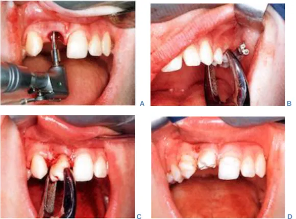 Figure 12 : Procédure d'autotransplantation d'une deuxième prémolaire maxillaire pour le  remplacement d’une incisive centrale maxillaire