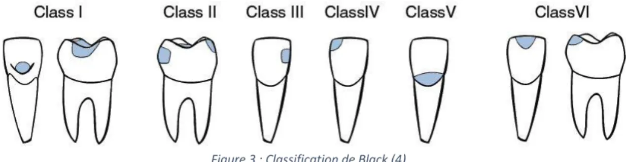 Figure 3 : Classification de Black (4) 