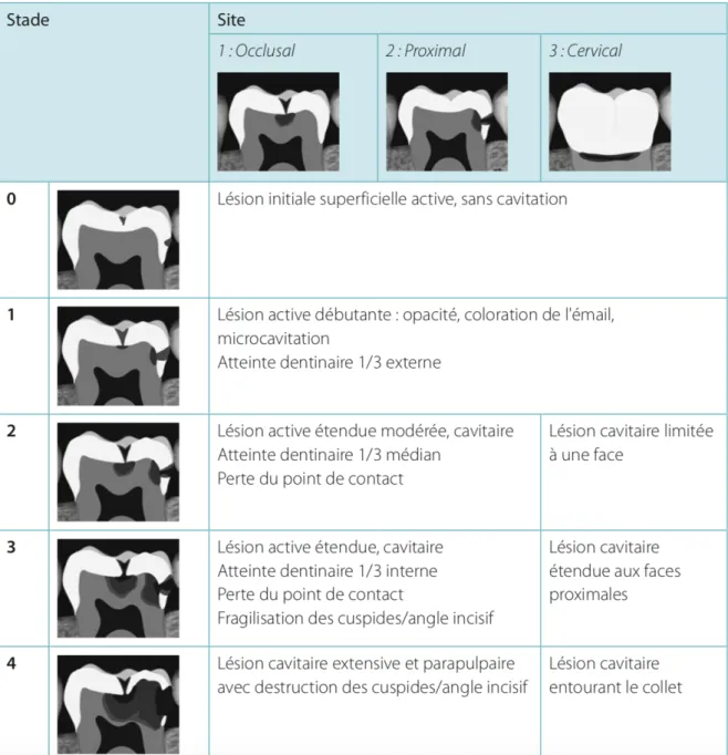 Figure 6: Illustration des différents sites et stades d’atteinte lésionnels décrits par la classification Si/Sta (8) 