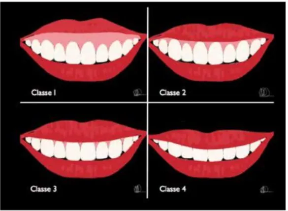 Fig. 28 classification de la ligne du sourire par Béliart  