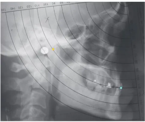 Fig. 29 : radiographie céphalométrique, Point jaune : axe charnière, Point bleu : bord libre de l’incisive mandibulaire