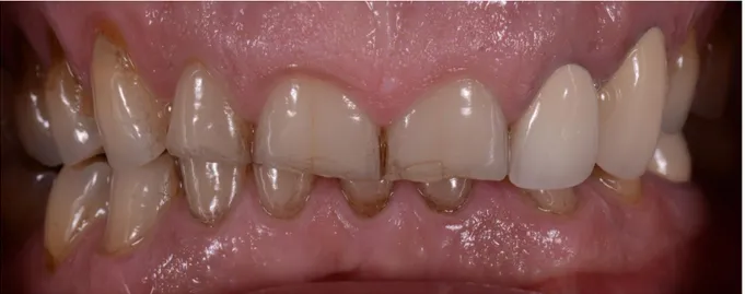 Fig. 36 : Occlusion initiale, vue de face  