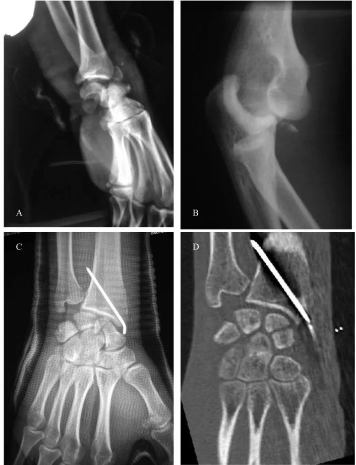 Figure 8 : fracture transcapholunaire postérieure stade 1 (A) associée à une fracture de la styloïde radiale et  à  une  luxation  du  coude  homolatérale  (B)  au  ski