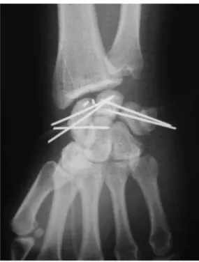 Figure 15 : luxation périlunaire pure :  arthrodèse provisoire après réparation  du ligament scapholunaire sur ancres 