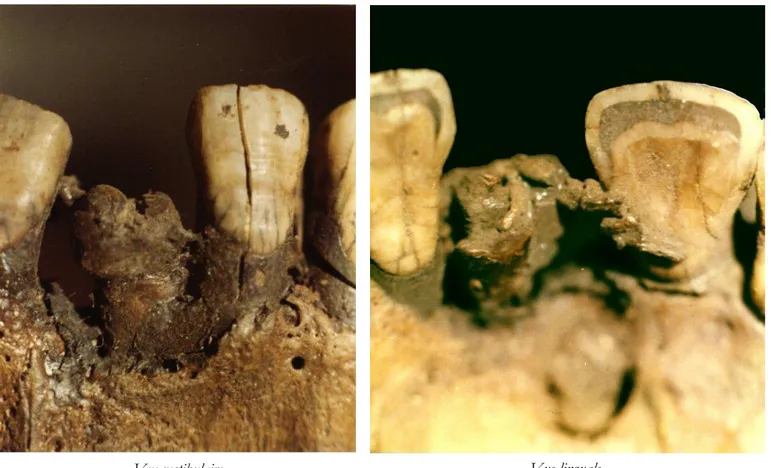 Figure 11 : Gros plans sur le crâne de Tura-El-Asmant. D’après J.J. Quenouille.  (72)