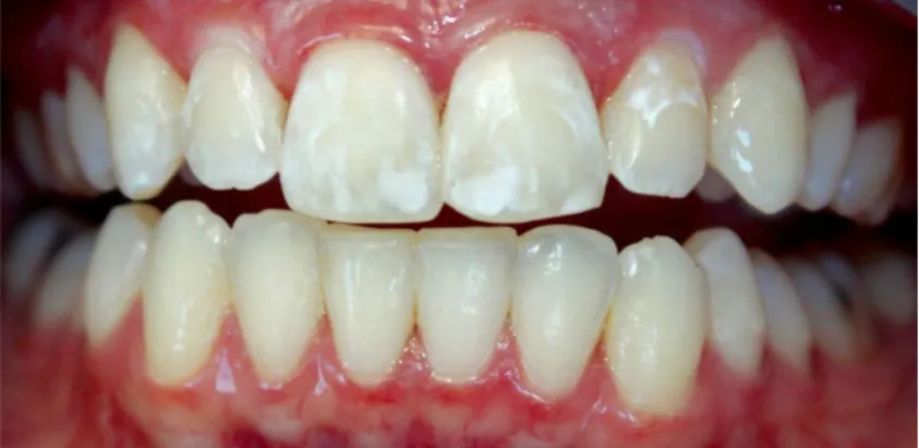 Figure 1 : Taches blanches ou white spot suite à la dépose de bagues orthodontique 