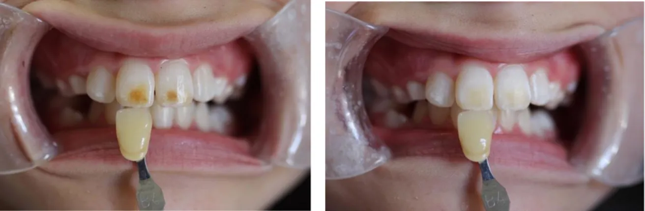 Figure 2 : Avant/après traitement de l’émail par microabrasion d’une tache brune ou brown spot   (Dentist West Windsor, NJ - David E