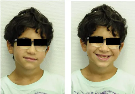 Figure 3: Photographies exobuccales d’Ismael à 7 ans (courtoisie Dr P. Rouas).
