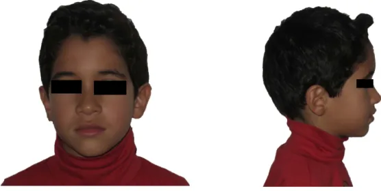 Figure 5: Photographies exobuccales d’Ismael à 8 ans 1/2  (courtoisie Dr M. Tsang Tung).