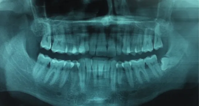Figure 2 : Engagé inapte dentaire temporaire (nécessite l’avulsion de la 38)