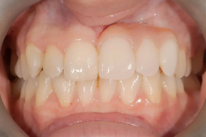 Figure 8 :Vue de face d’une patiente avec une prothèse amovible provisoire pour   remplacement des dents 21,22,23 à la suite de la pose d’implants 