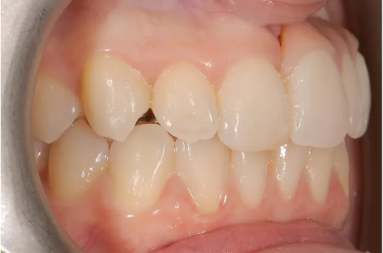 Figure 10 : Vue de profil d’une patiente avec une prothèse amovible provisoire pour  remplacement des dents 21,22,23 à la suite de la pose d’implants 