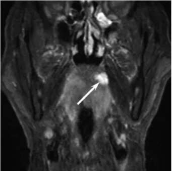 Figure 6 :  IRM d'un hémangiome palatin  (7) 