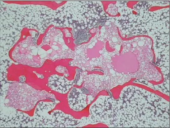Fig.  11.  Vision  à  fort  grossissement  de  cellules  vacuolisées  de  TBCN.  Ces  cellules  ressemblent  à  des  adipocytes  avec  de  larges  vacuoles  intra-cytoplasmiques