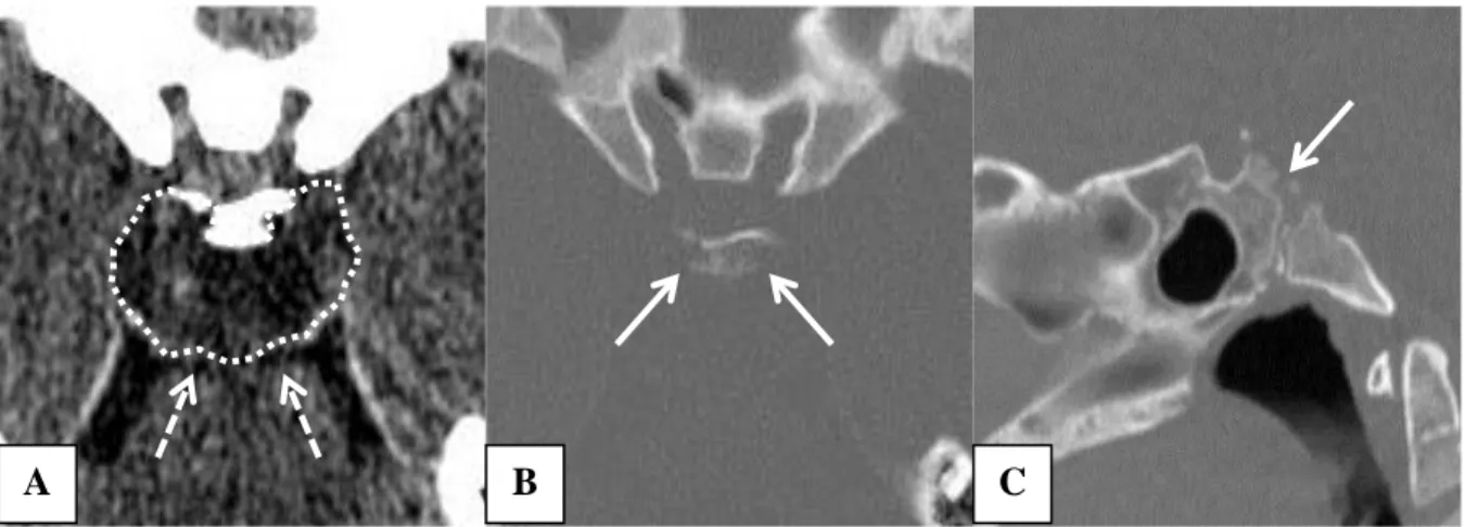 Fig.  15.  Chordome  du  clivus  en  acquisition  scanner  A.  Coupe  axiale  montrant  la  masse  hypodense  à  la  face postérieure du clivus (pointillés) et venant au contact du tronc cérébral (flèches) B