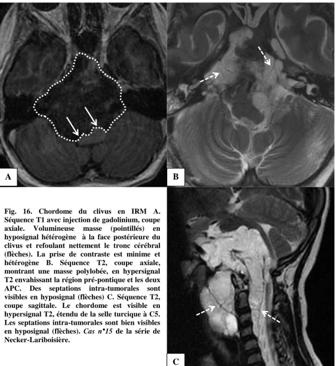 Fig.  16.  Chordome  du  clivus  en  IRM  A. 