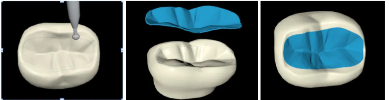 Fig. 14 : Préparation pour table top intracuspidien. 
