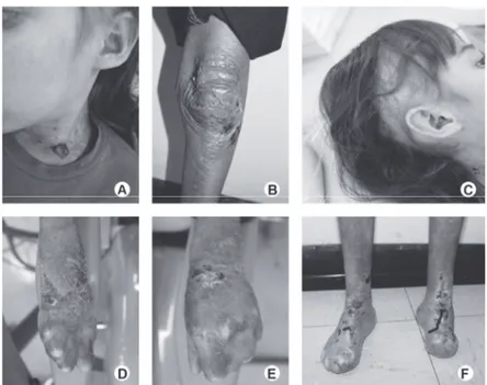 Figure 5 :  Lésions cutanées chez un enfant de 11 ans porteur d’une E.B.D.R. (d'après 11) A et B : Ulcérations cutanées au niveau du cou et du genou 