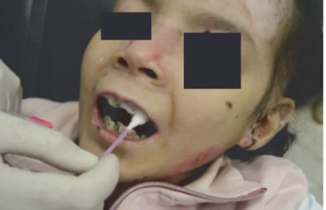 Figure 39: Application topique de vernis fluoré par un chirurgien-dentiste sur une patiente de 11 ans atteint d'E.B.D.R