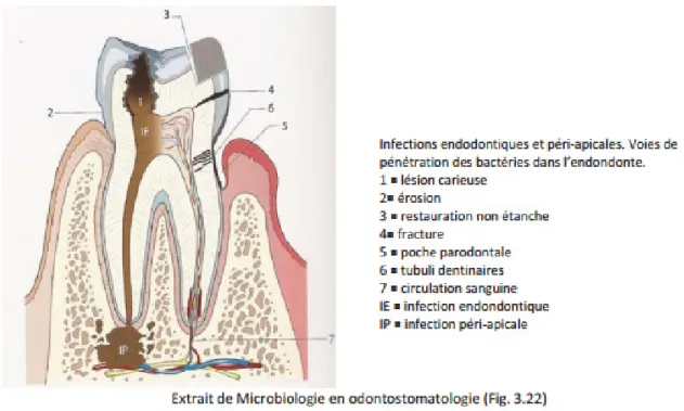 Figure 2 : Infections endodontiques et péri-apicales, voies de pénétration des bactéries dans  l'endodonte (5)(7)