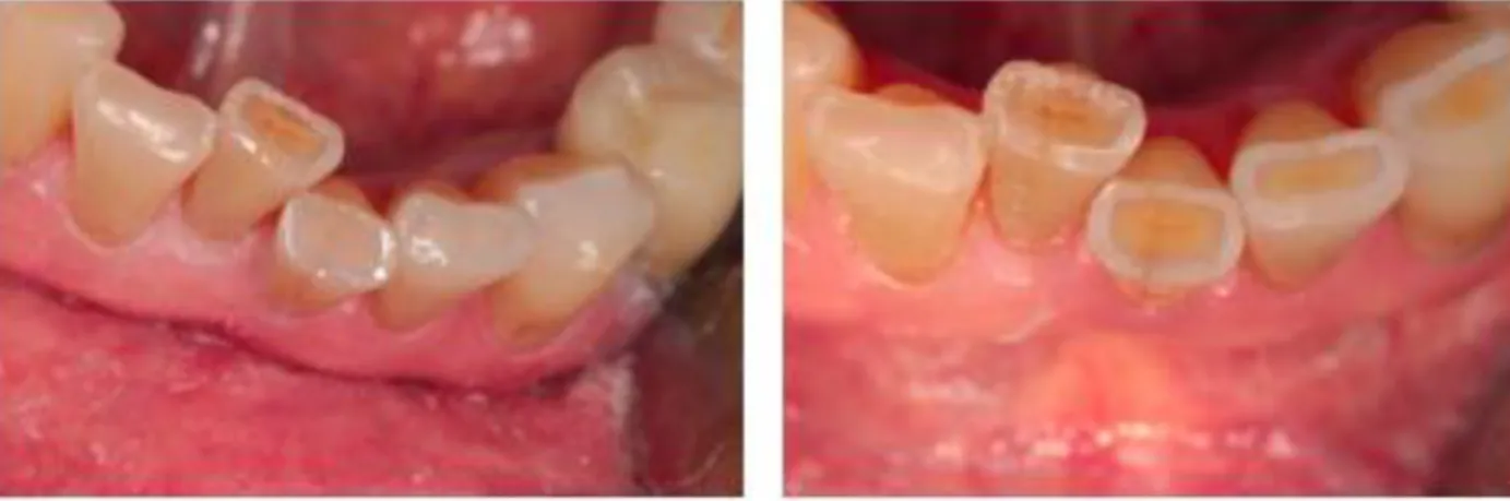 Figure 13 : Fêlures sur des incisives mandibulaires traitées par résine composite. (Photos Dr Bartala) 