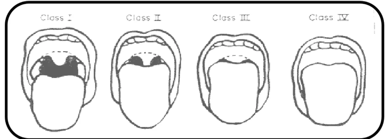 Figure 6 : Classification de Mallampati [67]. Classe I : les amygdales, les piliers et le palais  mou sont clairement visibles
