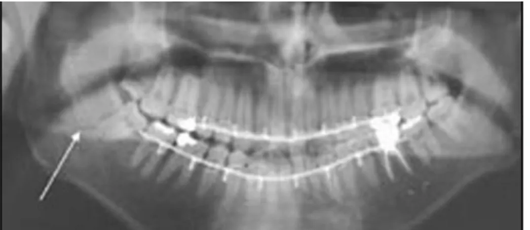 Figure 14 : Radiographie panoramique d’une fracture mandibulaire secteur 4 (2) (3) 