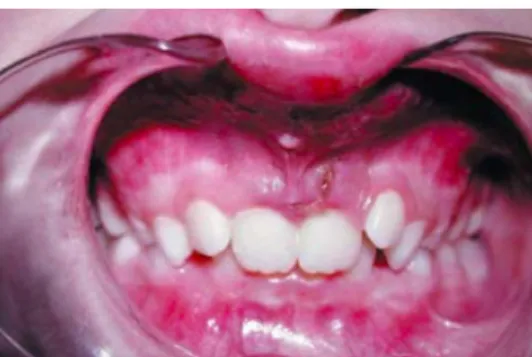 Figure 15 : Photographie intra buccale d’une lacération gingivale en regard de 21 (2) (3) 
