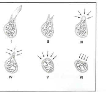 Figure 9 : Classification d’Atwood : phases d’évolution de la crête antérieure à la suite  d’extractions (7) 