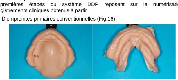 Figure 16 : Empreinte Primaire Maxillaire et Mandibulaire 