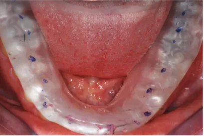 Figure 4. Équilibration de l’orthèse de reconditionnement musculaire : vue clinique. (6)