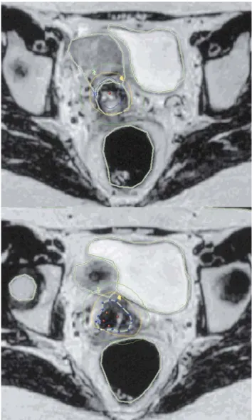 Figure 4. MR-assisted 3D treatment plan. (A) Three dimensional volumetric representation the 