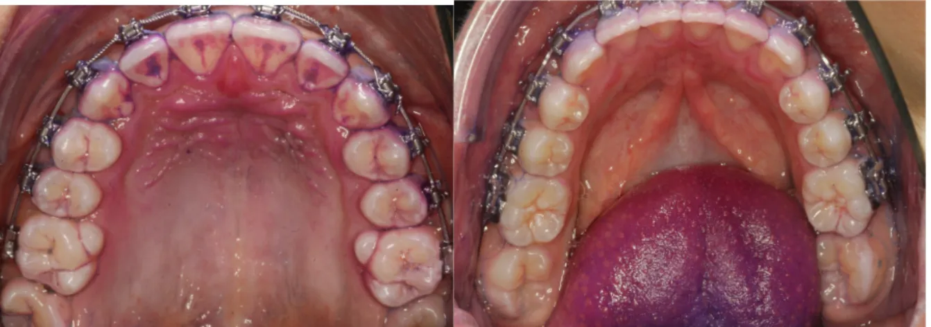 Figure 10 : Photographies intrabuccales vue occlusale, maxillaire et mandibulaire 